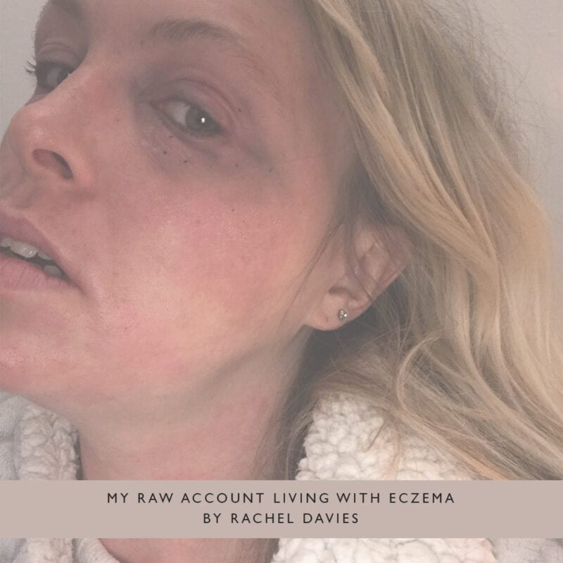 Pink-Link-Member-Blog-My-raw-account-living-with-eczema-by-Rachel-Davies